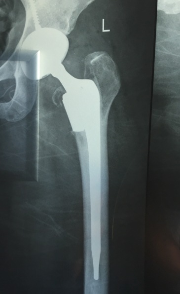 My new hip